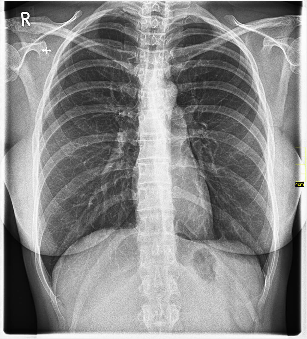 Thorax-Aufnahme Thorax-Aufnahme