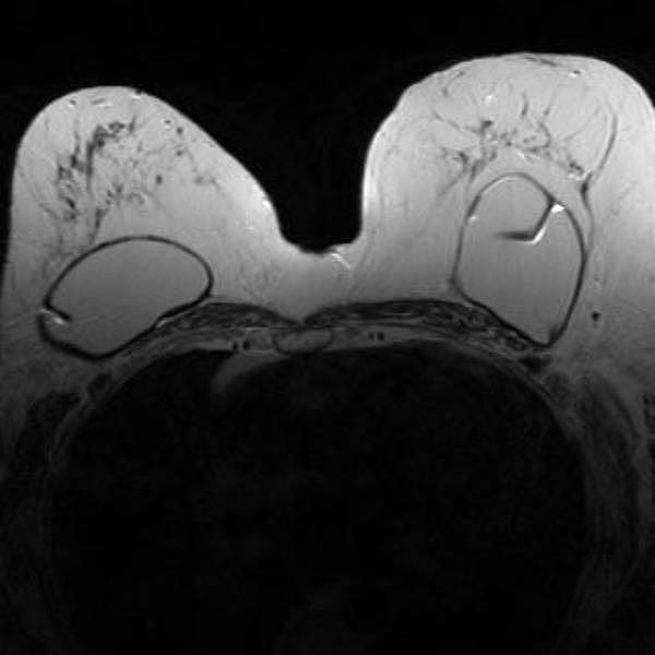 Darstellung von Implantaten (Silikon) im MRT Darstellung von Implantaten (Silikon) im MRT