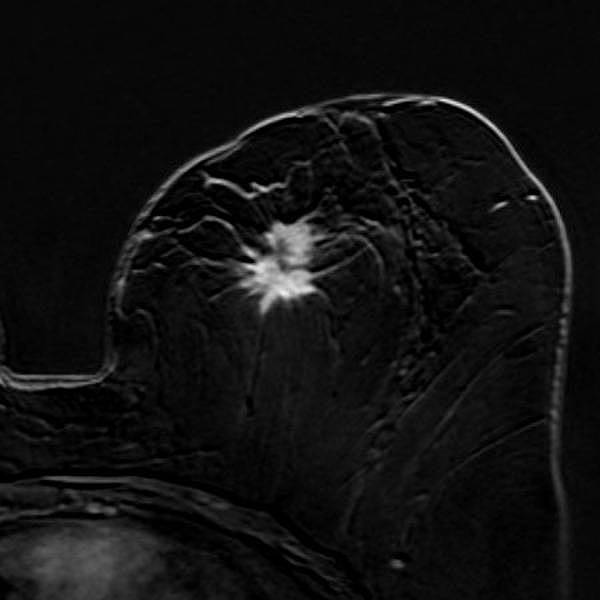 Brustkrebs: nach Kontrastmittel: Der Tumor reichert stark an Brustkrebs: nach Kontrastmittel: Der Tumor reichert stark an