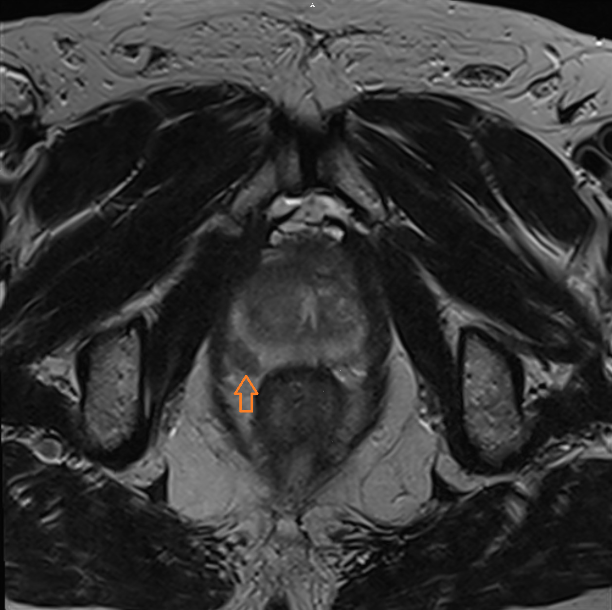 MRT der Prostata - Prostata-Carcinom MRT der Prostata - Darstellung eines Prostata-Carcinoms