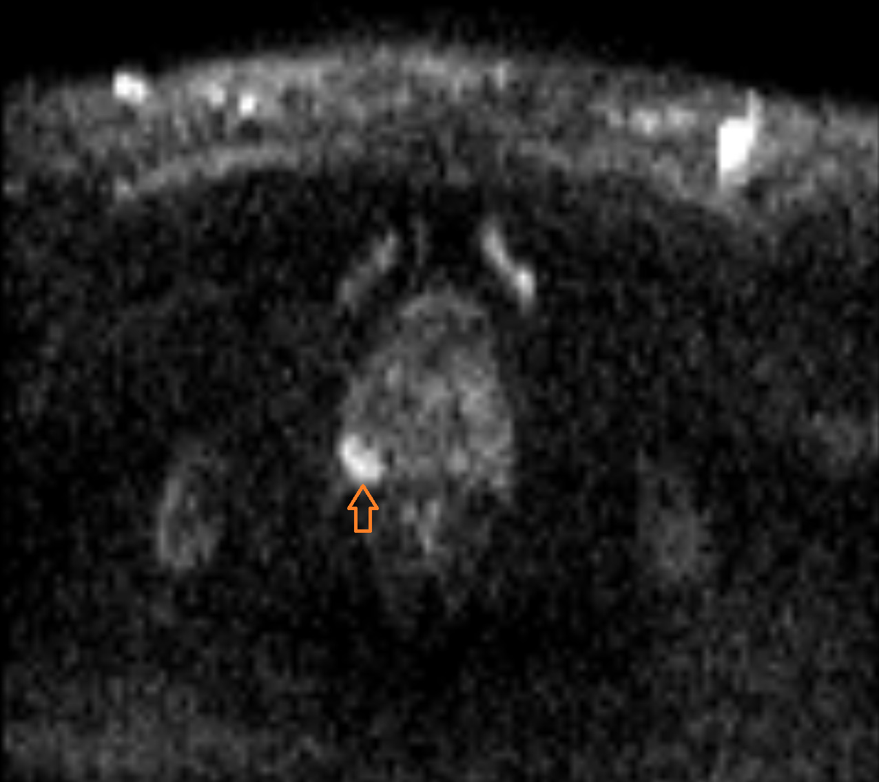 MRT der Prostata - Prostata-Carcinom (Diffusion) MRT der Prostata - Prostata-Carcinom (Diffusion)